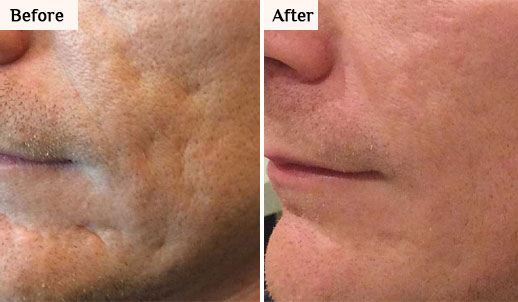 morpheus8 before after face